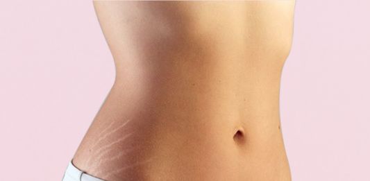 5 NATURAL REMEDIES FOR STRETCH MARKS | Beauty Tips By Nim | Nimisha Goyal | HashBUGS | BTN | beautytipsbynim.hashbugs.com