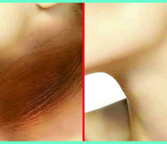 5 NATURAL REMEDIES FOR DARK NECK | Beauty Tips By Nim | Nimisha Goyal | HashBUGS | BTN | beautytipsbynim.hashbugs.com