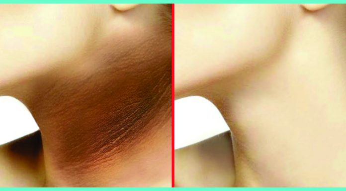 5 NATURAL REMEDIES FOR DARK NECK | Beauty Tips By Nim | Nimisha Goyal | HashBUGS | BTN | beautytipsbynim.hashbugs.com