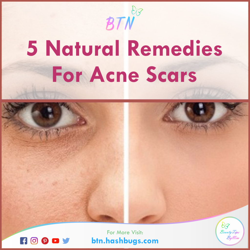 5 Natural Remedies For Acne Scars - Beauty Tips By Nim - Nimisha Goyal - HashBUGS - BTN - beautytipsbynim.hashbugs.com