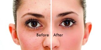 5 Natural Remedies For Acne Scars - Beauty Tips By Nim - Nimisha Goyal - HashBUGS - BTN - beautytipsbynim.hashbugs.com