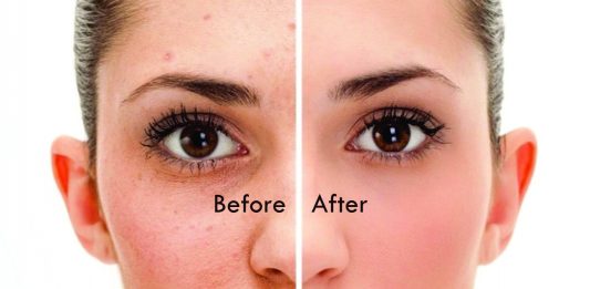 5 Natural Remedies For Acne Scars - Beauty Tips By Nim - Nimisha Goyal - HashBUGS - BTN - beautytipsbynim.hashbugs.com