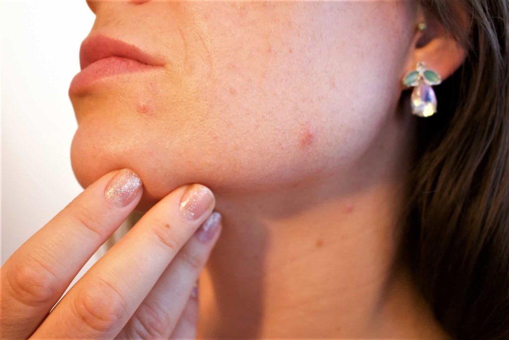 Causes of acne - Beauty Tips By Nim - Nimisha Goyal - HashBUGS - BTN - beautytipsbynim.com