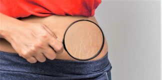 Proven Ways To Reduce Stretch Marks - Beauty Tips By Nim - Nimisha Goyal - HashBUGS - BTN - beautytipsbynim.com