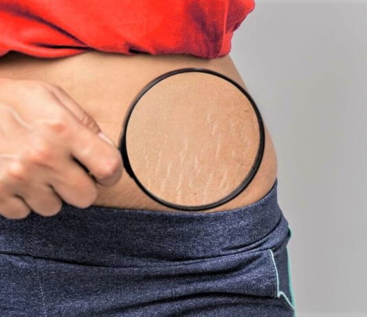 10 Proven Ways To Reduce Stretch Marks Proven Ways To Reduce Stretch Marks - Beauty Tips By Nim - Nimisha Goyal - HashBUGS - BTN - beautytipsbynim.com
