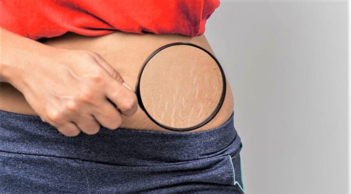 Proven Ways To Reduce Stretch Marks - Beauty Tips By Nim - Nimisha Goyal - HashBUGS - BTN - beautytipsbynim.com