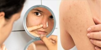 8 Ways to Treat Keratosis Pilaris Naturally - Real Simple - Chicken Skin Remedies - Beauty Tips By Nim - Nimisha Goyal - HashBUGS - BTN - Nimify Beauty - beautytipsbynim.com