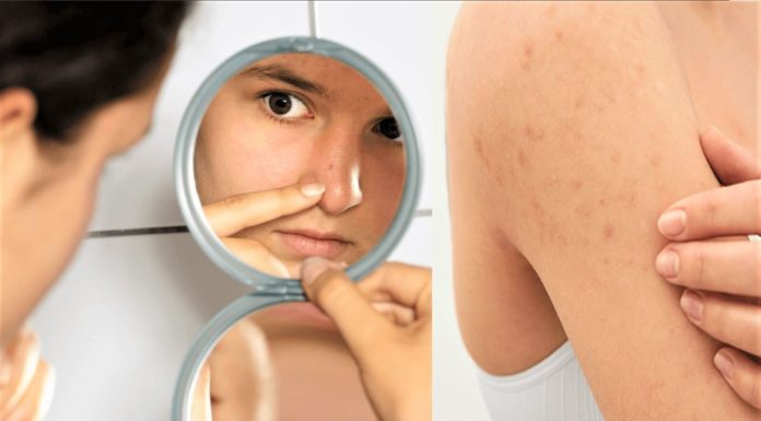 8 Ways to Treat Keratosis Pilaris Naturally - Real Simple - Chicken Skin Remedies - Beauty Tips By Nim - Nimisha Goyal - HashBUGS - BTN - Nimify Beauty - beautytipsbynim.com