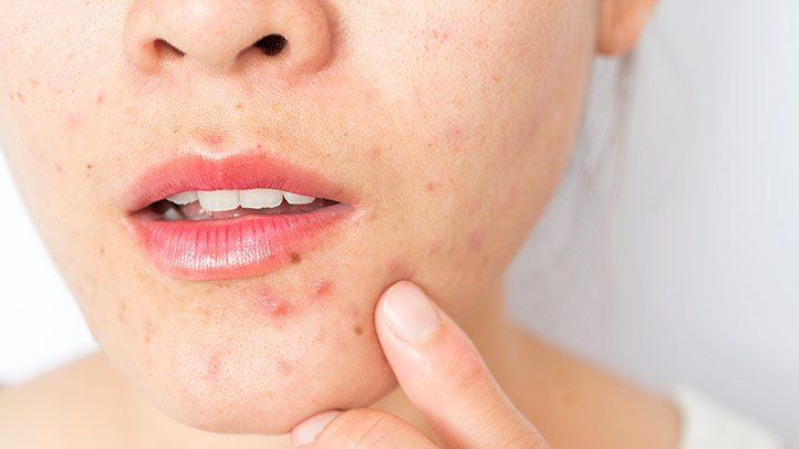 Acne-Related Redness on the Skin - Beauty Tips By Nim - Nimisha Goyal - HashBUGS - BTN - Nimify Beauty - beautytipsbynim.com