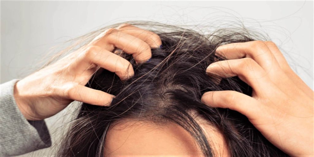 Do Not Be Tempted To Scratch - Hair Fall - Beauty Tips By Nim - Nimisha Goyal - HashBUGS - BTN - Nimify Beauty - beautytipsbynim.com
