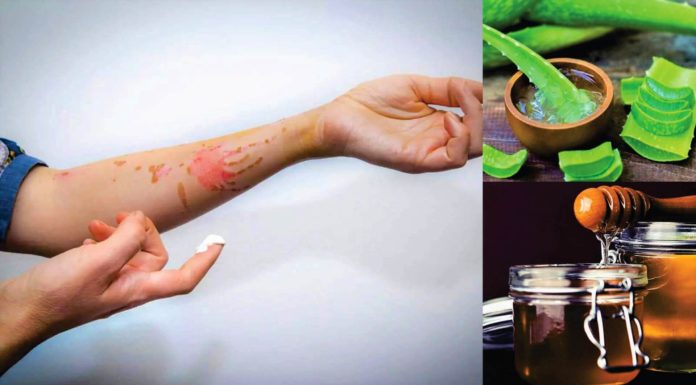 Oil Burn Treatment - 10 Easy Ways to Treat It - Beauty Tips By Nim - Nimisha Goyal - HashBUGS - BTN - Nimify Beauty - beautytipsbynim.com (2)