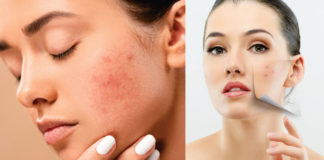 Tips to Control Excess Redness on the Face With Pictures - Beauty Tips By Nim - Nimisha Goyal - HashBUGS - BTN - Nimify Beauty - beautytipsbynim.com