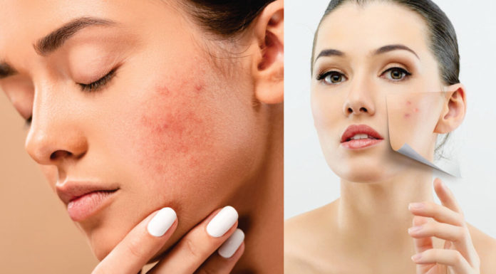 Tips to Control Excess Redness on the Face With Pictures - Beauty Tips By Nim - Nimisha Goyal - HashBUGS - BTN - Nimify Beauty - beautytipsbynim.com