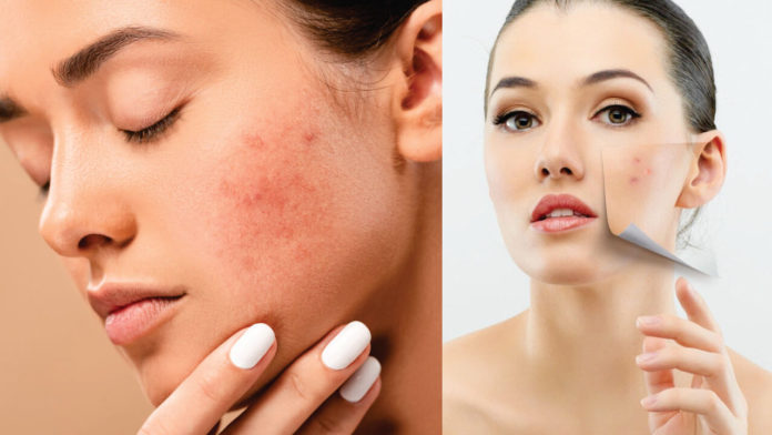 Tips to Control Excess Redness on the Face With Pictures - Beauty Tips By Nim - Nimisha Goyal - HashBUGS - BTN - Nimify Beauty - beautytipsbynim.com