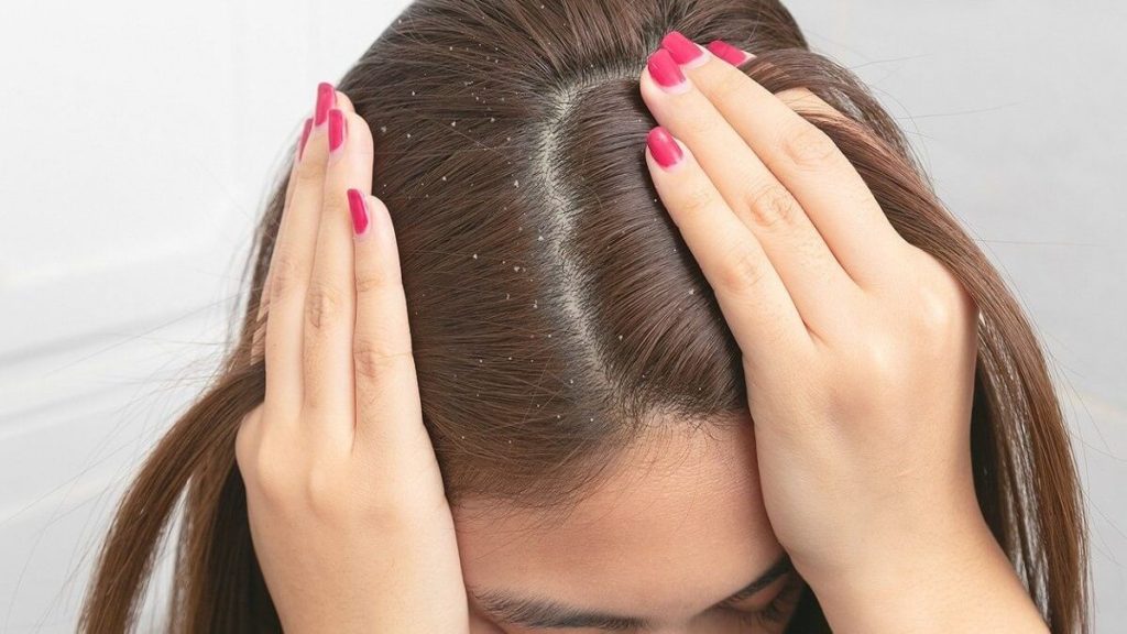 4. Dandruff - How Sesame Oil Is Beneficial for Your Hair Pro Tips - Beauty Tips By Nim - Nimisha Goyal - HashBUGS - BTN - Nimify Beauty - beautytipsbynim.com