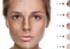What Is Pigmentation on Face - Causes, Types and Treatment - Beauty Tips By Nim - Nimisha Goyal - HashBUGS - BTN - Nimify Beauty - beautytipsbynim.com