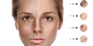 What Is Pigmentation on Face - Causes, Types and Treatment - Beauty Tips By Nim - Nimisha Goyal - HashBUGS - BTN - Nimify Beauty - beautytipsbynim.com