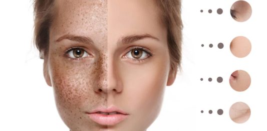 What Is Pigmentation on Face - Causes, Types and Treatment - Beauty Tips By Nim - Nimisha Goyal - HashBUGS - BTN - Nimify Beauty - beautytipsbynim.com