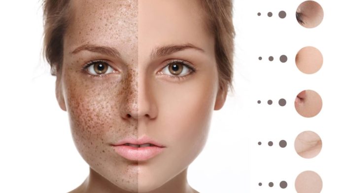 What Is Pigmentation on Face - Causes, Types and Treatment - Beauty Tips By Nim - Nimisha Goyal - HashBUGS - BTN - Nimify Beauty - beautytipsbynim.com